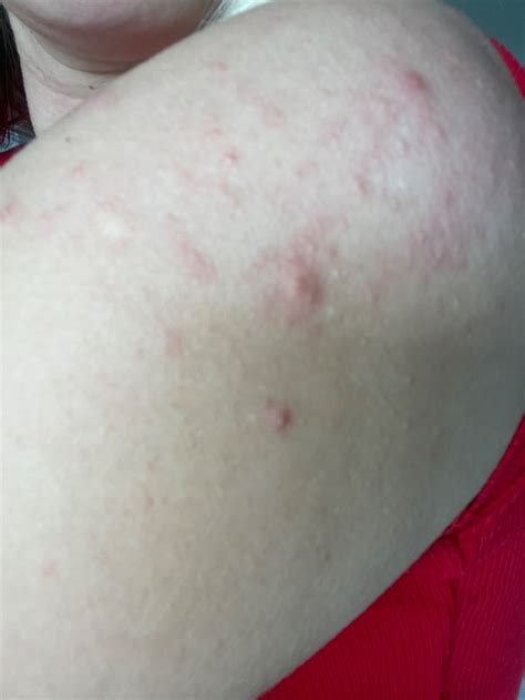 Ilustrácia typickej ružovej vyrážky pri šiestej chorobe na trupe dieťaťa