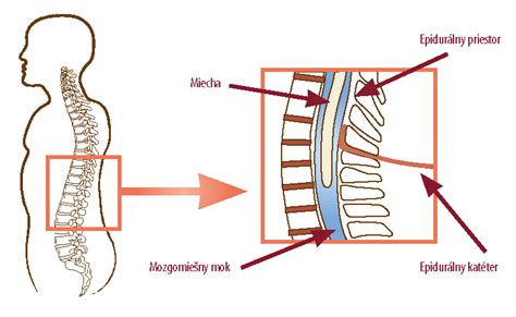 Infografika zobrazujúca proces epidurálnej analgézie počas pôrodu