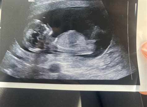 Ultrazvukové fotografie bábätka z 2. trimestra