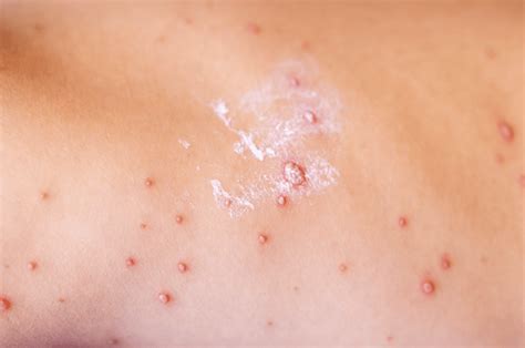 Ilustrácia rôznych typov vyrážok u detí (napr. osýpky, ovčie kiahne, šarlach)