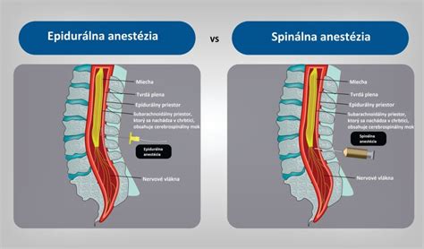 Porovnanie spinálnej a celkovej anestézie pri cisárskom reze