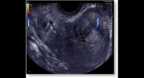 ultrazvukové zobrazenie maternice