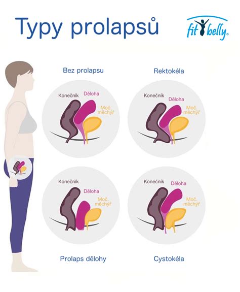 Infografika s porovnaním rôznych typov liečby prolapsu maternice
