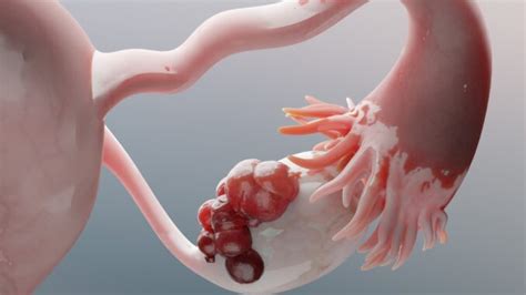 Ilustrácia vaječníka s cystou