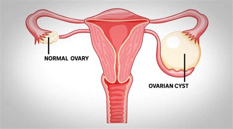 Infografika znázorňujúca rôzne typy ovariálnych cýst