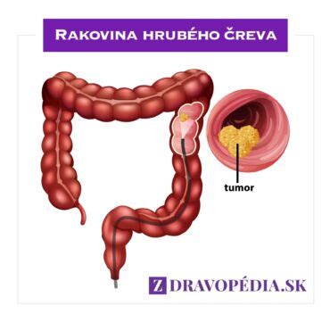 Ilustrácia hrubého čreva s vyznačením sliznice a možných vredov.