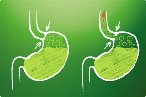 Grafické znázornenie refluxu pažeráka s vyznačením dolného pažerákového zvierača.