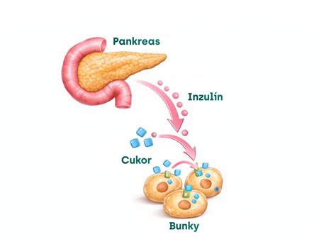Ilustrácia znázorňujúca pankreas a bunky produkujúce inzulín.