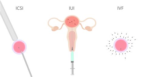 Ilustrácia základných metód asistovanej reprodukcie: IVF, ICSI, IUI