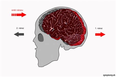 Infografika zobrazujúca príznaky otrasu mozgu u detí.