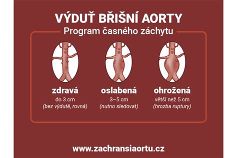 Schematické znázornenie brušnej aorty s vyznačenými hlavnými vetvami