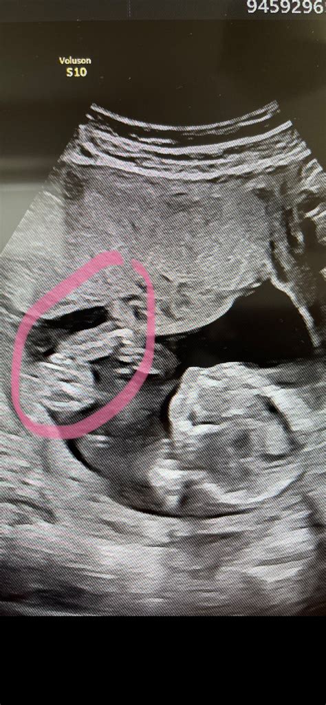 Zobrazenie malej panvy ženy pomocou transvaginálneho ultrazvuku s vyznačenou maternicou a vaječníkmi