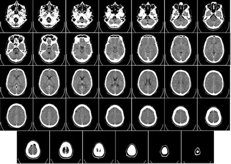 Infografika porovnávajúca príznaky otrasu mozgu u detí a dospelých