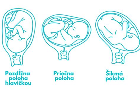 Ilustrácia znázorňujúca správne a nesprávne umiestnenie vnútromaternicového telieska v maternici.